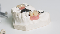 義歯治療 イメージ画像